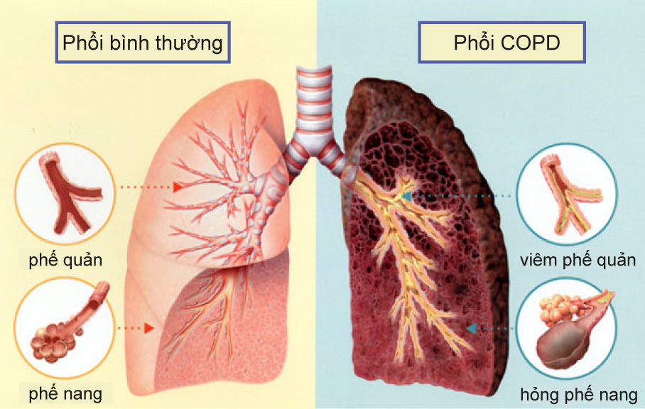 Dấu hiệu nhận biết bệnh phổi tắc nghẽn mạn tính 1