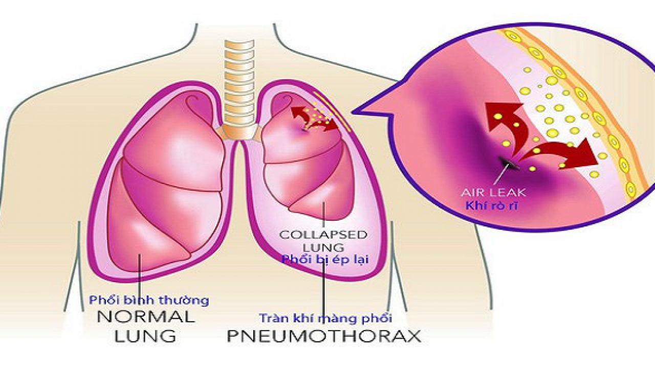 Tràn khí màng phổi 1
