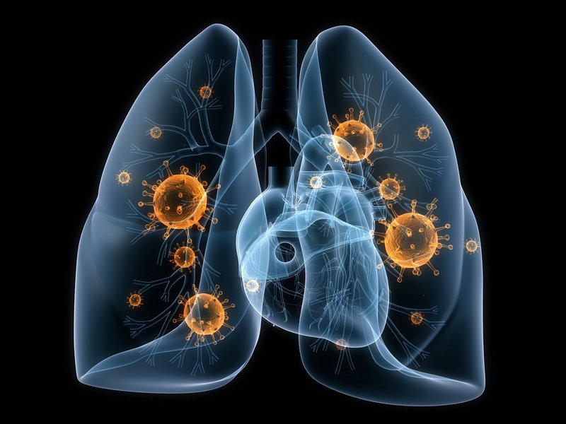 Khái quát về viêm phổi mắc phải tại cộng đồng 1